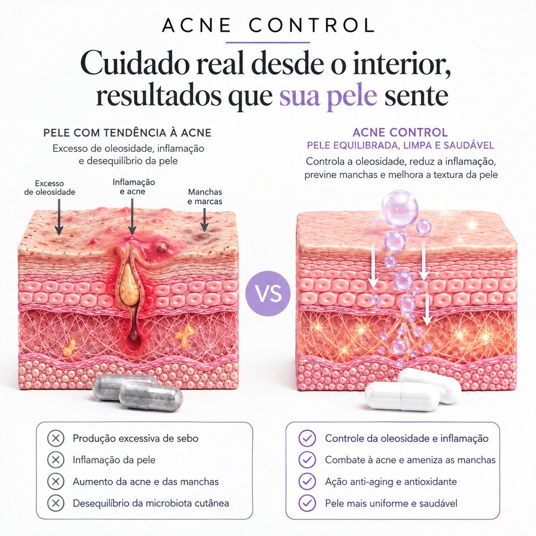 Ilustração da pele com tendência à acne comparada à pele equilibrada com Acne Control